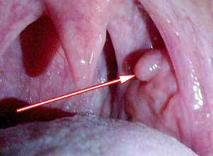 Papillome dans le larynx