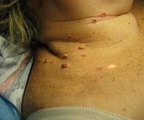 papillomavirus humain sur le cou