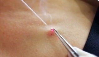 élimination des papillomes dans le corps avec un laser